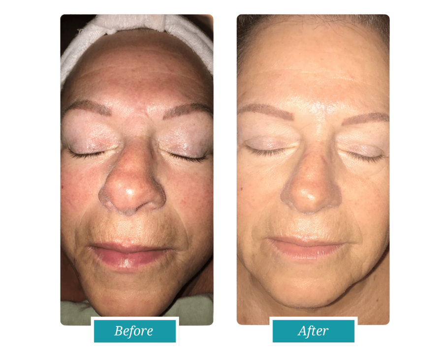 med spa facial before & after results