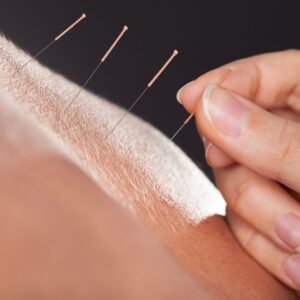 close-up of acupuncture needles