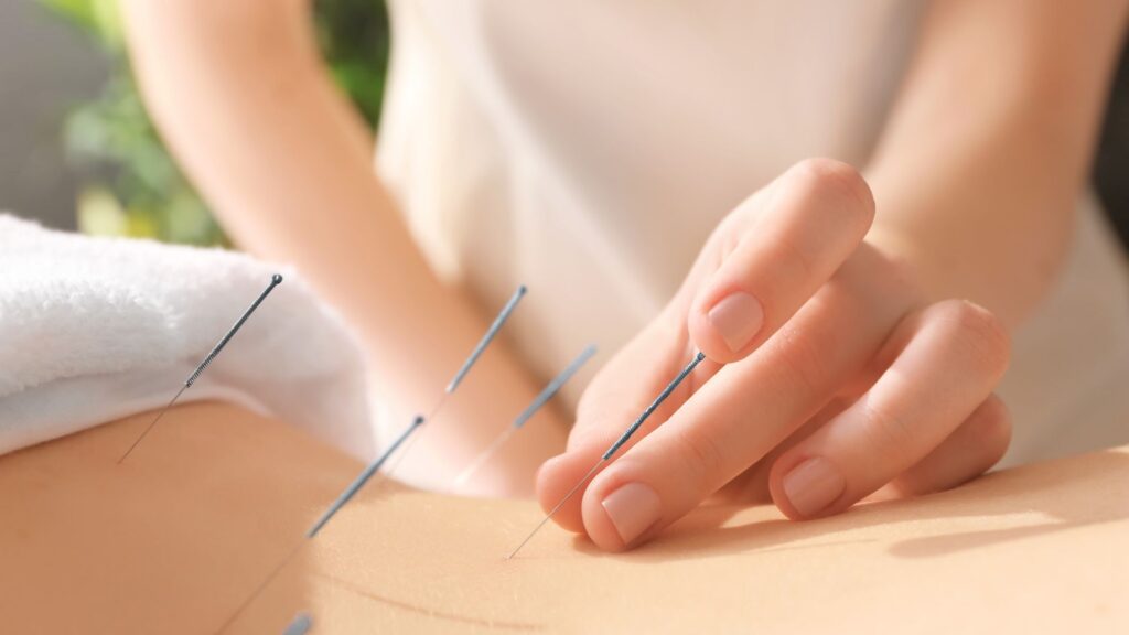 placing acupuncture needles